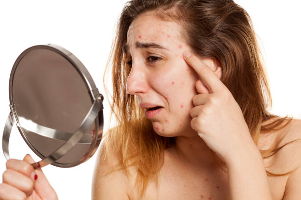 A young woman examining her acne using a handheld mirror, appearing concerned about her skin condition.