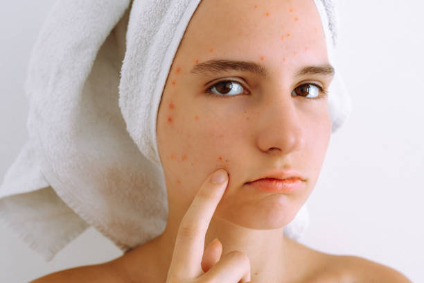 Teenage girl with acne touching her face, looking concerned